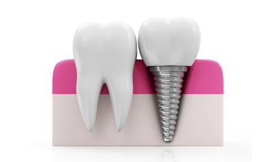 Remplacement d'une dent par
une racine artificielle et couronne